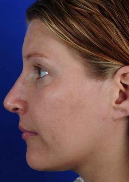 Revision Rhinoplasty Before & After Patient #1825