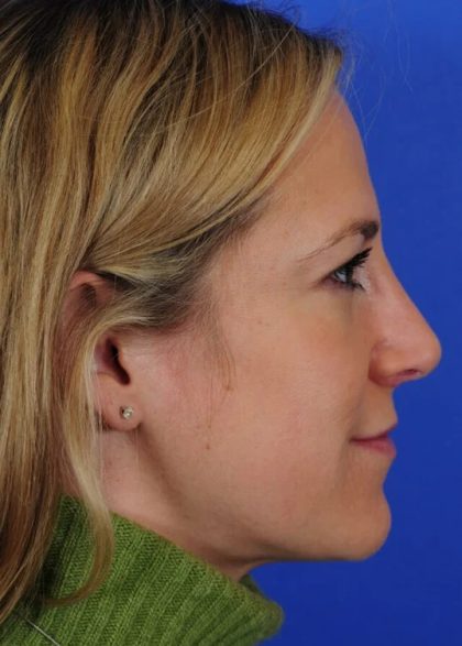 Primary Rhinoplasty Before & After Patient #1653