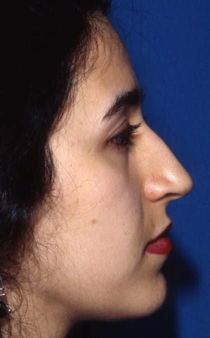 Primary Rhinoplasty Before & After Patient #1654