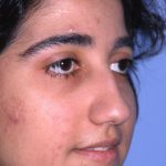Ethnic Rhinoplasty Before & After Patient #2038