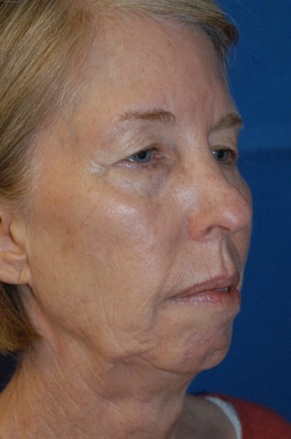 Facelift Neck Lift Before & After Patient #2274