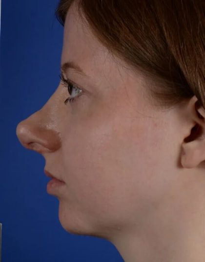 Revision Rhinoplasty Before & After Patient #1922
