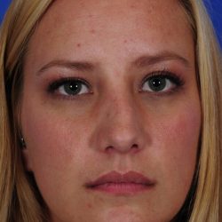 Revision Rhinoplasty Before & After Patient #1868