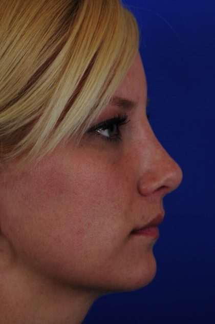 Revision Rhinoplasty Before & After Patient #1868