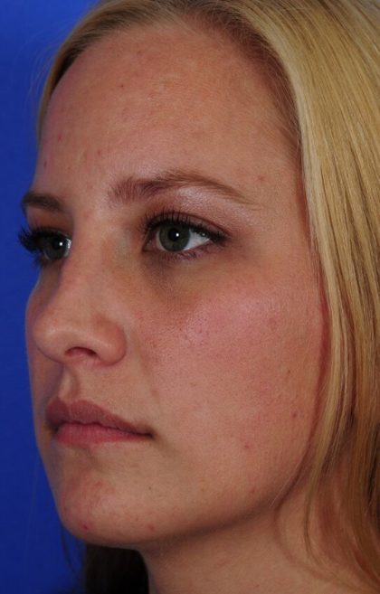 Revision Rhinoplasty Before & After Patient #1868