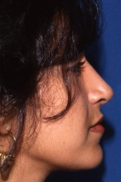 Primary Rhinoplasty Before & After Patient #1654