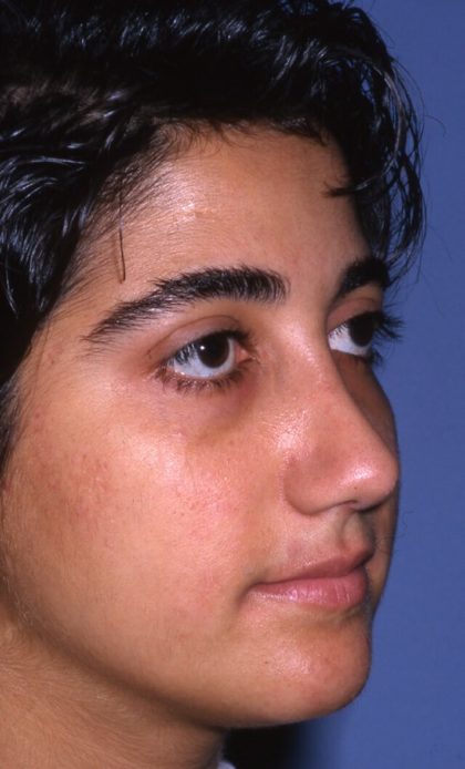 Ethnic Rhinoplasty Before & After Patient #2038