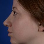 Revision Rhinoplasty Before & After Patient #1922
