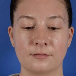 FaceTite and NeckTite Before & After Patient #2388
