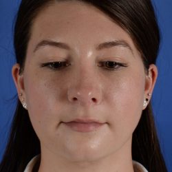 FaceTite and NeckTite Before & After Patient #2388