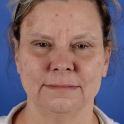 FaceTite and NeckTite Before & After Patient #2389