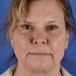 FaceTite and NeckTite Before & After Patient #2389