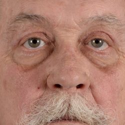 Blepharoplasty Before & After Patient #2161
