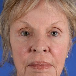 Juvederm® Before & After Patient #2392