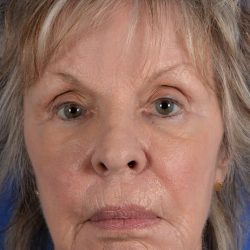Juvederm® Before & After Patient #2392