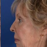 Juvederm® Before & After Patient #2392
