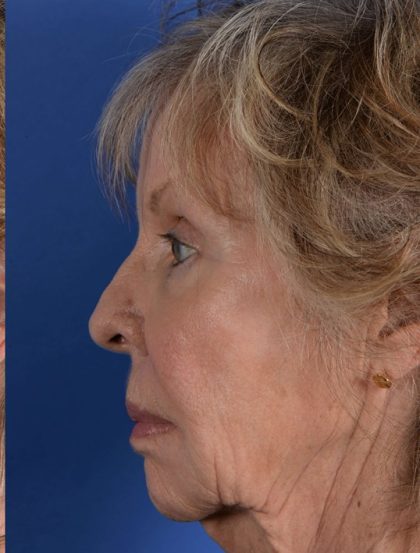 Juvederm® Before & After Patient #2392