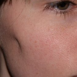 Facial Fat Transfer Before & After Patient #2323