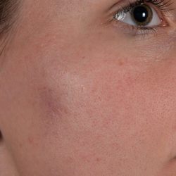 Facial Fat Transfer Before & After Patient #2323