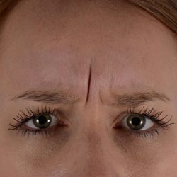 Botox® Before & After Patient #2391