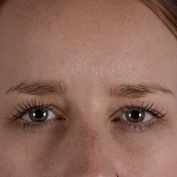 Botox® Before & After Patient #2391