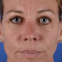 Revision Rhinoplasty Before & After Patient #1869
