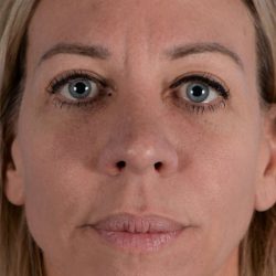 Revision Rhinoplasty Before & After Patient #1869
