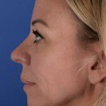 Revision Rhinoplasty Before & After Patient #1869