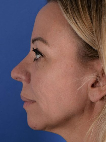 Revision Rhinoplasty Before & After Patient #1869