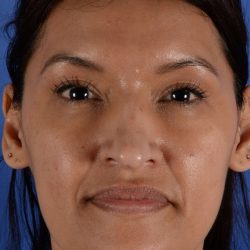 Primary Rhinoplasty Before & After Patient #1650