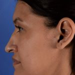 Primary Rhinoplasty Before & After Patient #1650