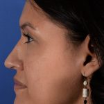 Primary Rhinoplasty Before & After Patient #1650