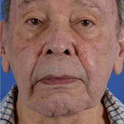Face Lift - Neck Lift Before & After Patient #2232
