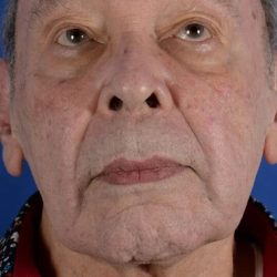 Face Lift - Neck Lift Before & After Patient #2232