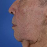 Facelift Neck Lift Before & After Patient #2232