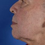 Facelift Neck Lift Before & After Patient #2232