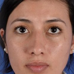 Ethnic Rhinoplasty Before & After Patient #1972