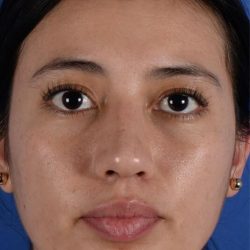Ethnic Rhinoplasty Before & After Patient #1972