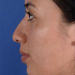 Ethnic Rhinoplasty Before & After Patient #1972