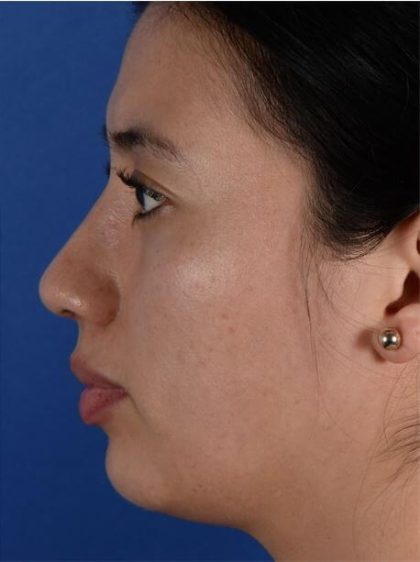 Ethnic Rhinoplasty Before & After Patient #1972