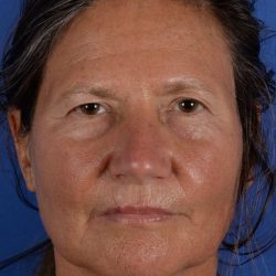 Forehead Lift Brow Lift Before & After Patient #2363