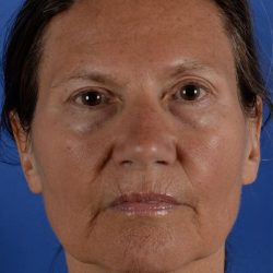 Blepharoplasty Before & After Patient #2163