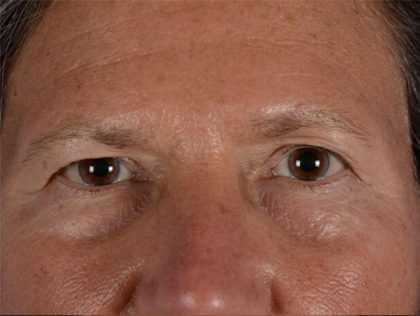 Blepharoplasty Before & After Patient #2163