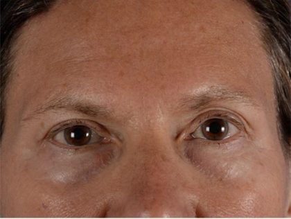 Blepharoplasty Before & After Patient #2163
