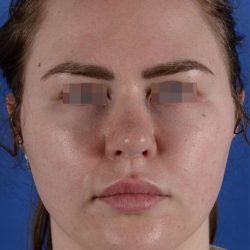 Primary Rhinoplasty Before & After Patient #1649
