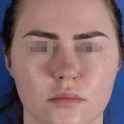 Primary Rhinoplasty Before & After Patient #1649