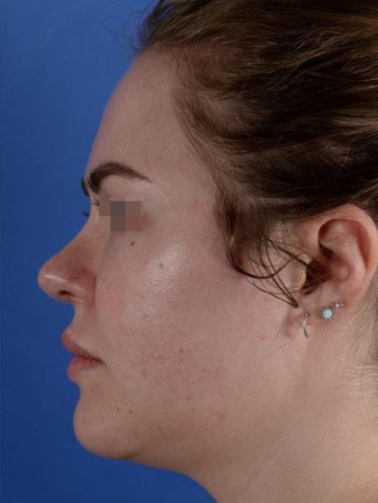 Primary Rhinoplasty Before & After Patient #1649