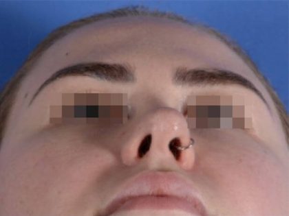 Primary Rhinoplasty Before & After Patient #1649