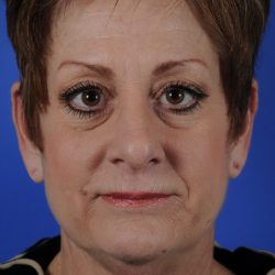 Facial Fat Transfer Before & After Patient #2325