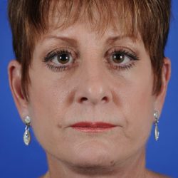 Facial Fat Transfer Before & After Patient #2325